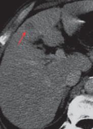 ábra: UH kontrasztanyag halmozás Forrás: Magyar Radiológia - Harkányi Zoltán 2008 CT-vizsgálat: natív CT vizsgálattal a HCC izo- vagy hipodenz, ritkábban tartalmaz zsírt is, jellemző denzitásértékkel.