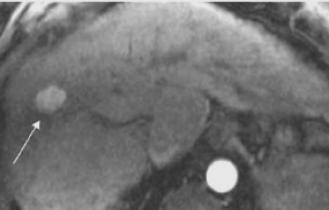 MR-vizsgálat: a T1 súlyozott MR-felvételen a HCC jelgazdag lehet, ugyanakkor, szemben más tumorokkal, a T2 súlyozott képeken sokszor nem különül el szembetűnően a környezetétől (izodenz), csak a