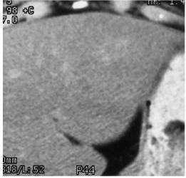 ábra: UH kontrasztanyag halmozás Forrás: Magyar Radiológia - Harkányi Zoltán 2008 CT-vizsgálat: az FNH natív CT-n többnyire hipodenz, rendkívül gyors, dinamikus festődést mutat az artériás fázisban.