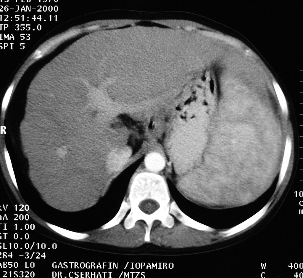 Focalis periportalis sparing Jellemzők: diffúz zsíros átalakulás típusos lokalizáció a bal lebeny medialis