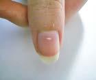 PROIZVODI Promjene boje noktiju Bijele točke na noktu leukonihia, ukazuje na manjka cinka ali i moguć slabiji rad štitnjače.