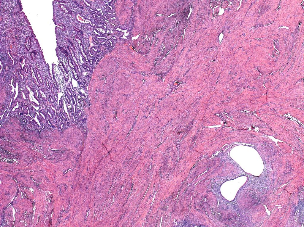 Adenomyosis Endometrialis