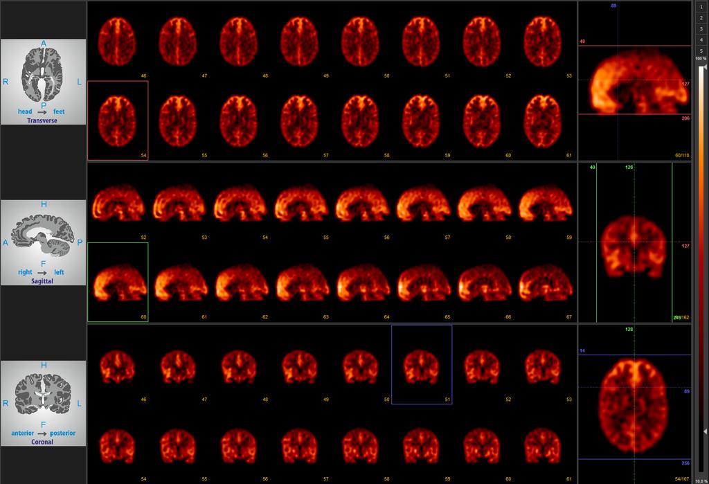 kamera Mediso AnyScan TM SPECT/CT kollimátor LEHR izotóp Tc99m aktivitás 600M Bq projekciós képek száma 128 projekciós képek mérete 256 256 pixelméret 1.