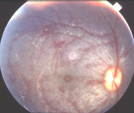 factor. Invest Ophthalmol Vis Sci 1996 Aug;37(9): 1929-34. Tolentino, M.J., et al.