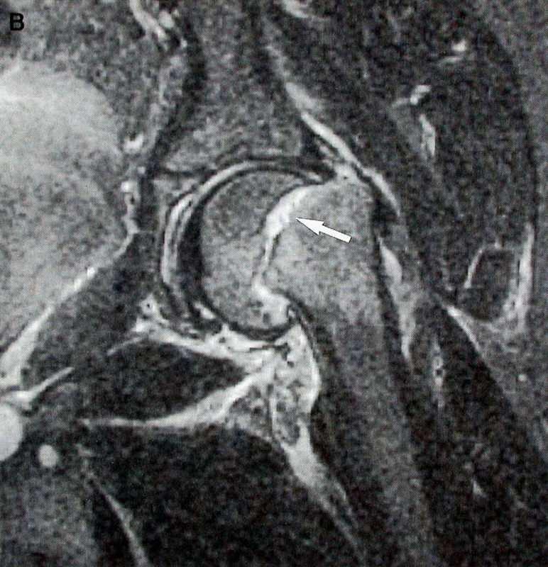 Slipped Capital Femoral Epiphysis MRI SCFE SCFE in in aa 12 12 years years old old boy.