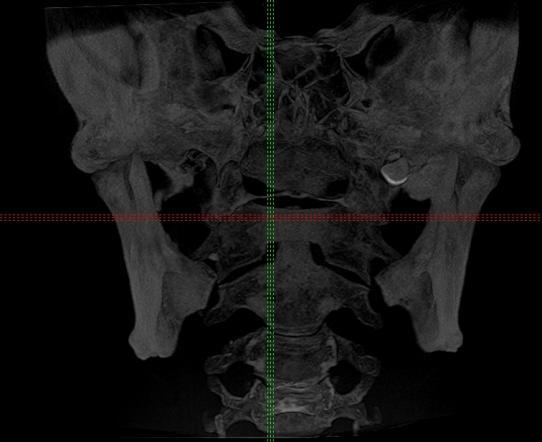 fordítja centrális sugár mandibula