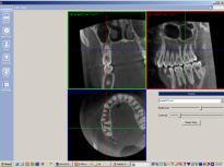 overwrite) TMJ position selection programs to match diagnostic