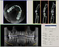 software 3D explorer 3D viewer 3D panoramic view implant