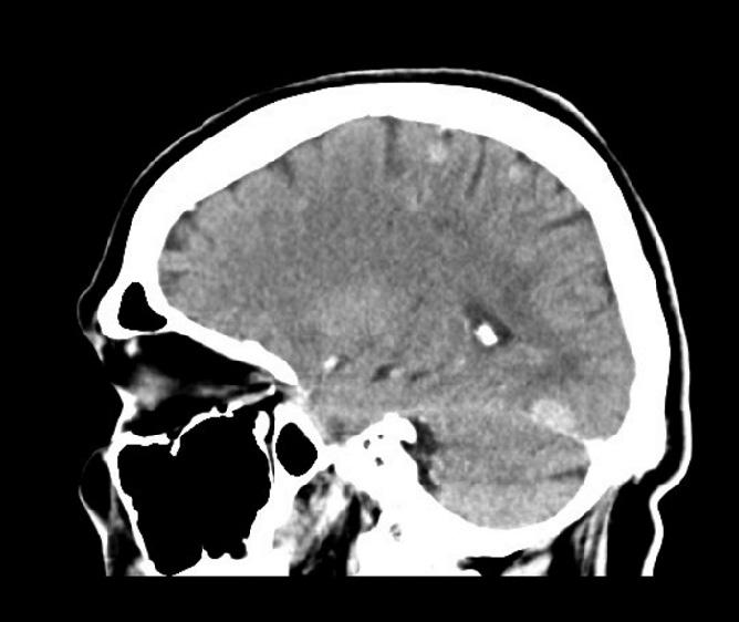 Négy hónap intrathecalis kemoterápia mellett a jobb infraclavicularis régióban 6 cm-es, tapintható nyirokcsomó-konglomerátum jelent meg. Intrathecalis kezelését felfüggesztettük.