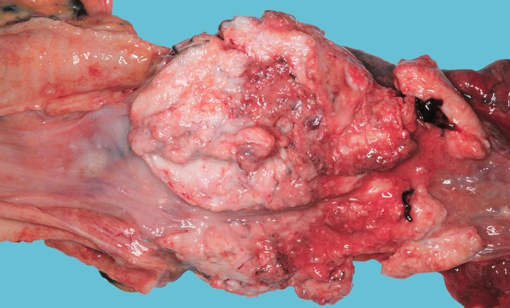 A nyelőcső alsó harmadában lévő carcinoma progresszív stenosist és dysphagiát okozott