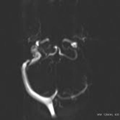 3. ábra MR venográfia hypoplasias bal oldali vénás elvezetés. Bal oldalon a thrombosis helyén hiányzik az áramlási jel. (Saját anyag) 3.1.