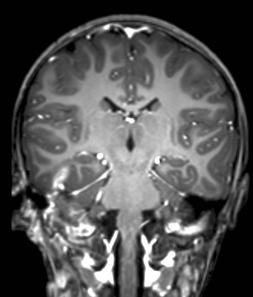 ábra Koponya MRI vizsgálat eredménye.