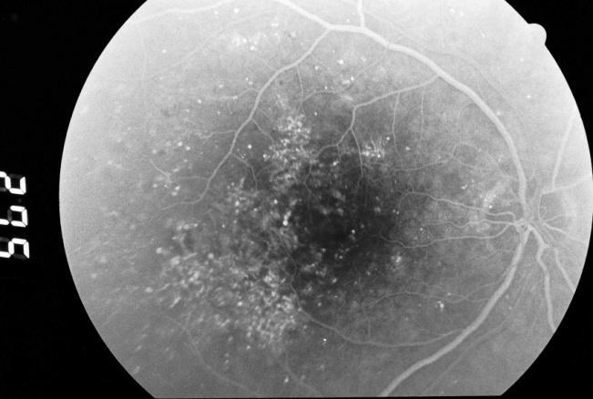 A fluoreszcein angiográfia jól demonstrálja a vér-retina barrier defektusát - itt festékkilépést látunk (8. ábra). A közelmúltban az OCT (9. ábra, 10.