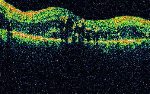 (A kép a szerző saját anyagából származik.) A diabeteses macula oedema járhat fokális vagy diffúz retina megvastagodással, exsudatumokkal vagy anélkül.