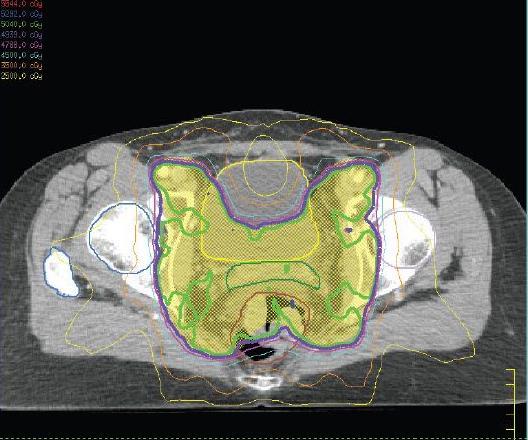 (IMRT) Rectum, hólyag és belek