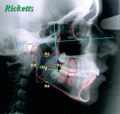 Fogak várható előtörésének előrejelzése - Teleröntgen Ricketts analízis Alsó bölcsességfog o Xi pont: ramus mandibulae szerkesztett centruma. (linguala) o DF2MI: 2. nagyőrlő distalis kontaktpontja.