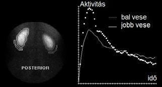 Biológiai kiürülés + fizikai bomlás A bomlási valószínűségek adódnak össze: λ fiz +λ biol =λ eff 1 λ = ln 2 T T eff Λ hyperfunkció hypofukció 1 1 = + T T fiz biol exponenciális T eff t Vesefunkció