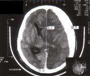 PAPILLA OEDEMA Összehasonlítás diagnosztikai kritériumok KNyF & IIH Deborah I. Freadman: Papilledema, in: Clin Neuro-Ophthalmolgy (Ed: N. R Miller, N. J Newman,2005. Ch.- 5.