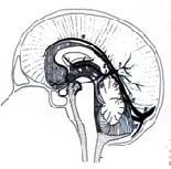 The International Study On Cerebral Vein and Dural Sinus Thrombosis (ISCVT) Prognosis of Cerebral Vein and Dural sinus thrombosis (624 pts.) José M.