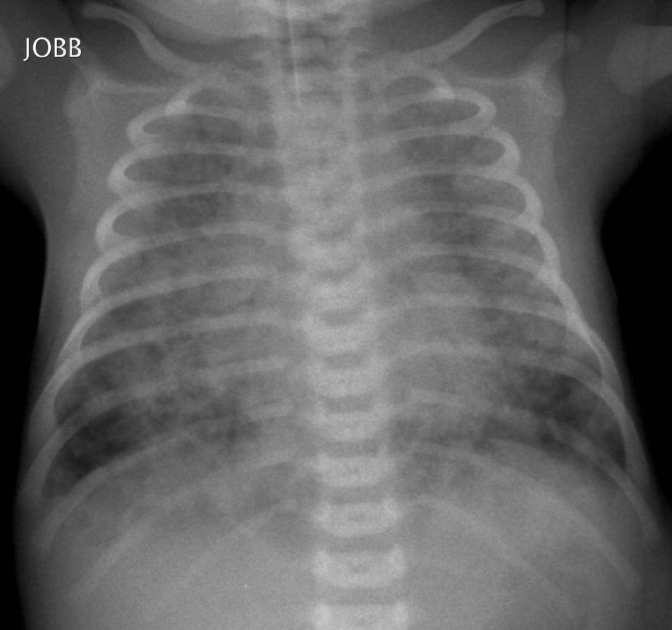 MEKONIUM ASPIRÁCIÓS SYNDROMA Fetalis hypoxia vagus stimulatio mekonium ürítés a