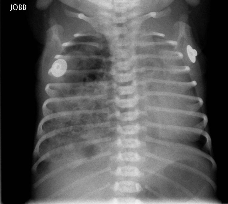 1.CPAM congenital pulmonary airway malformation Congenitalis cysticus adenomatoid malformatio