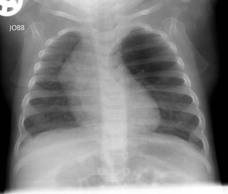 emphysema (CLE) Fokozódó felfújtság