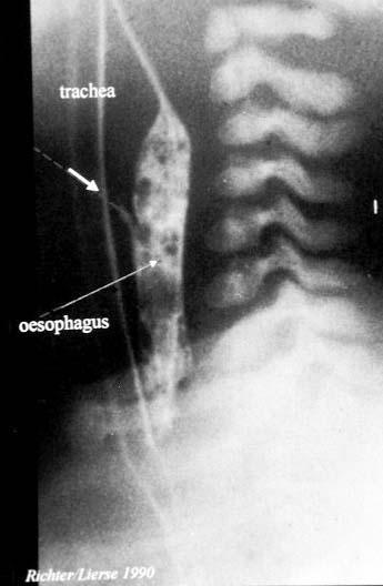 H-fistula