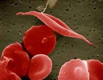 9 A hemoglobin egyik közismert rendellenessége a sarlósejtes vérszegénység.