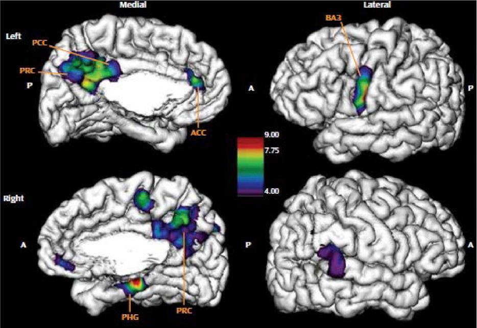 Funkcionális következmények emberben: fmri Emotional/sexual abuse