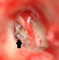 10. ábra: Az arteria stapedia persistenst adó arteria meningea media, és ellátási területe (baloldal) (A); Az arteria maxillárisból eredő kollaterális érhálózat ellátási területe (baloldal,