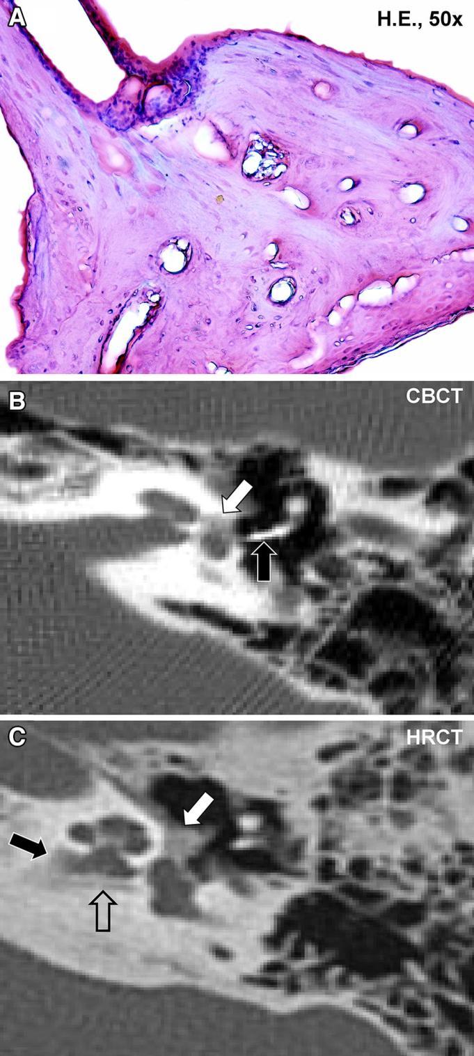 25. ábra Mérsékelt aktivitású, szövettanilag igazolt otosclerosis (jobb fül). Otoscleroticus fókusz a stapes talp anterior pólusánál (HE).