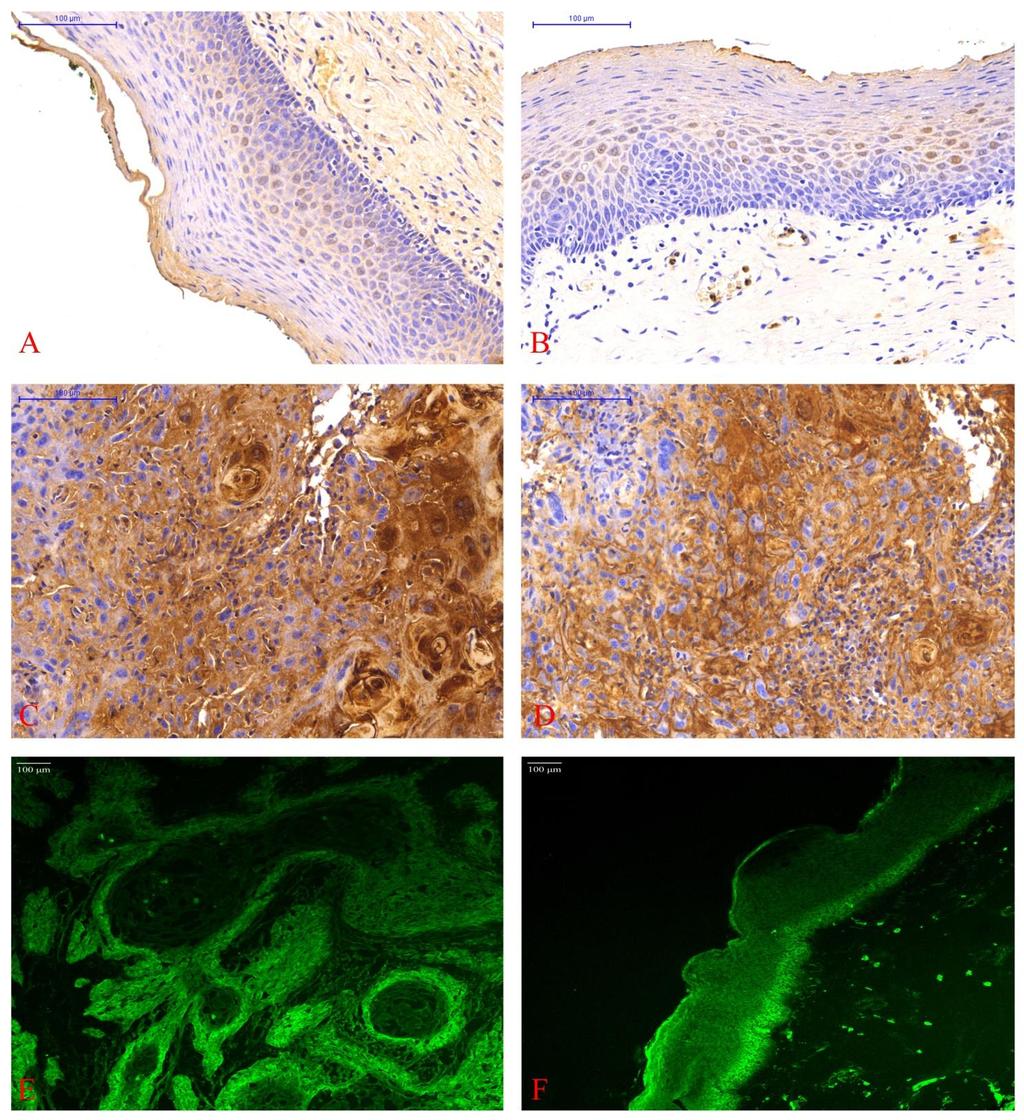 21. ábra: Immunhisztokémia és fluoreszcens konfokális mikroszkópia eredményei a B2-s mintán. Panel A és B az S100A8 és A9 festődését mutatja a normál hámban.