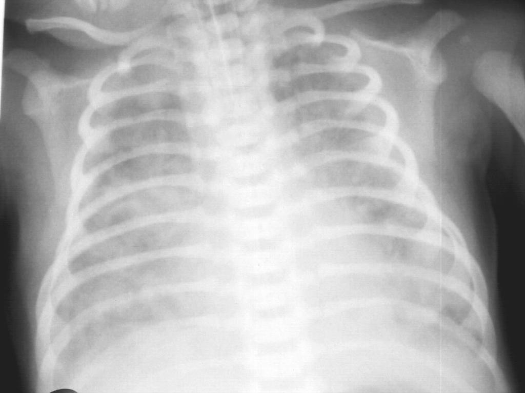 MECONIUM ASPIRATIO Meconium intrauterin v.