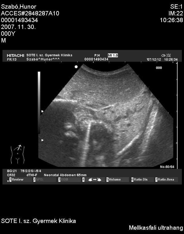 (14-25%) újszülöttkor Artériás ellátás: aorta (abdominalis)