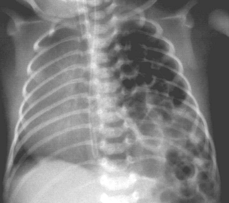 Rekeszsérv ELİFORDULÁS: 1/4000 születés Bal oldal 80 % Tüdı hypoplasia, persistaló foetalis keringés - i.u.