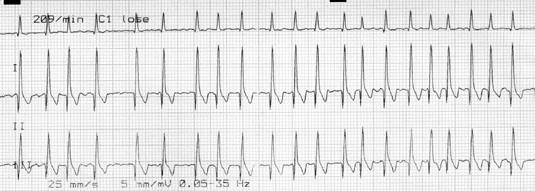 2.ábra: Pitvarremegés EKG-képe Esetenként az ingerképzési góc a kamrai izomzatban is előfordulhat, ami leggyakrabban korai ismételt kamrai extrasystolet vált ki.