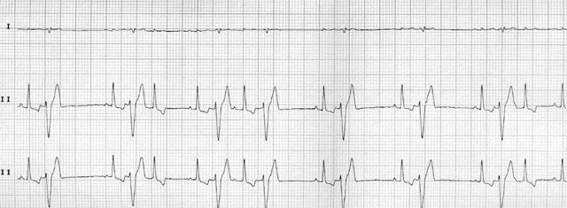 ábrán látható a normál és abnormál QRS-komplexus. A kamrai tachycardia általában súlyos fokú szívizom-károsodást jelez, amennyiben az oka kardiális eredetű.