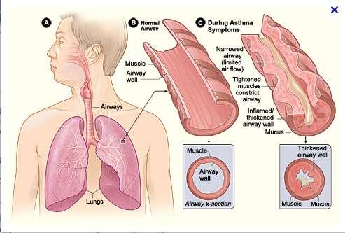 4. Asthma bronchiale A légutak krónikus gyulladásos megbetegedése,