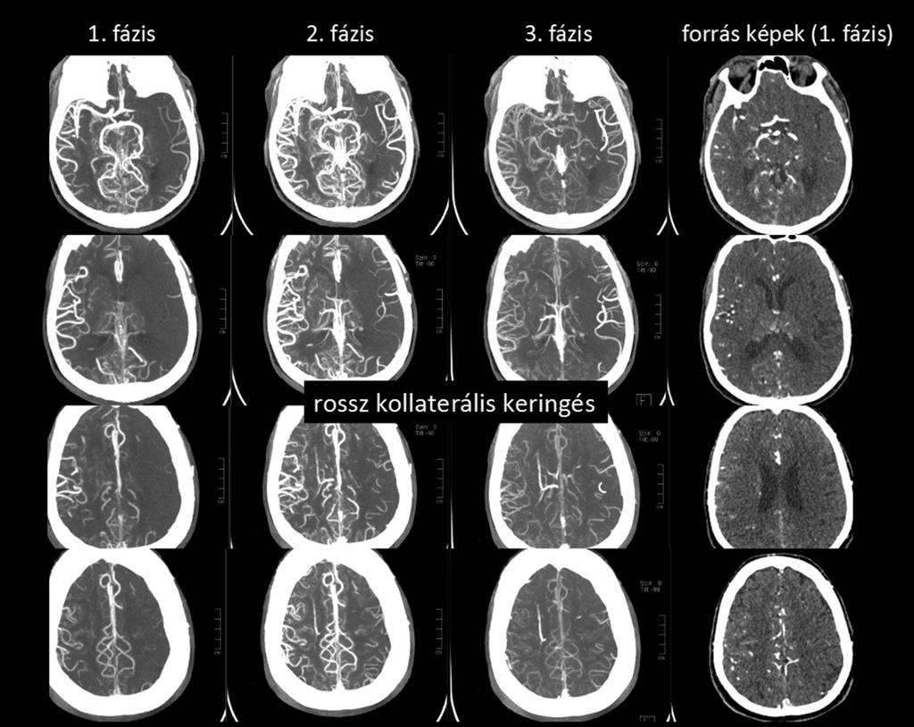 9. ábra. Rossz kollaterális keringés. Bal oldali ACM occlusio. Az 1.
