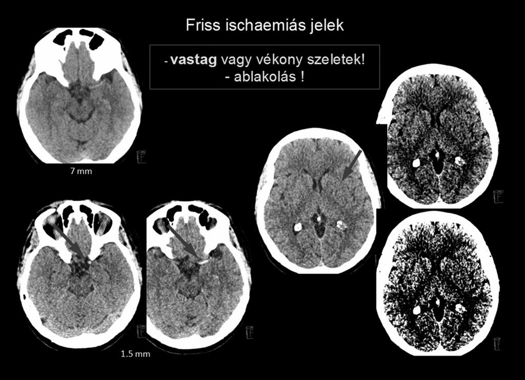 Nehezítik a korrekt ASPECTS-értékelést a krónikus ischaemiás eltérések és műtermékek.