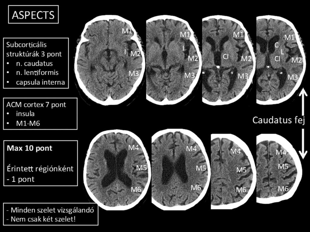 Bár a kóros hiperdenzitás legtöbbször az ACM-ben azonosítható (első leírója Gács Gyula), megjegyzendő, hogy a többi basalis artériában (ACI, ACA, AV, a.