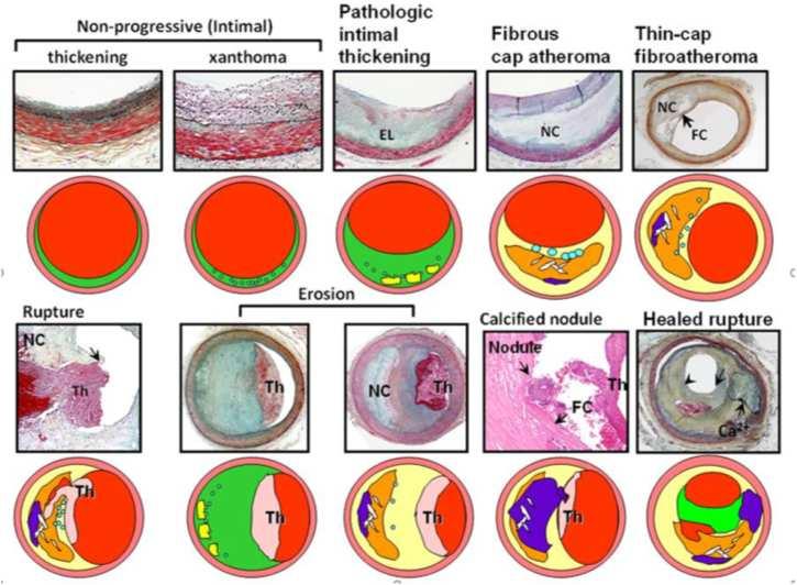 2. Koronária betegség Incidencia 1,4 18% Radioterápia: rizikó <<< antraciklinek, fiatalok, magas dózisok (>30 Gy), shielding hiánya, CV rizikó, CAD Fluoropyrimidinek (5-Fluorouracil, capecitabin,