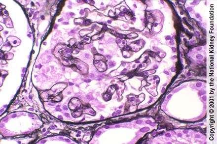 Collapsing glomerulopathia kapilláris kacs collapsusa podocyták hyperplasiája rossz