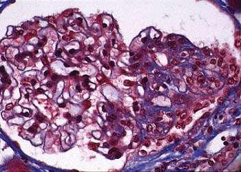 Perihilaris megjelenés Leggyakoribb Secunder - Oligomeganephronia - Nephron pusztulás