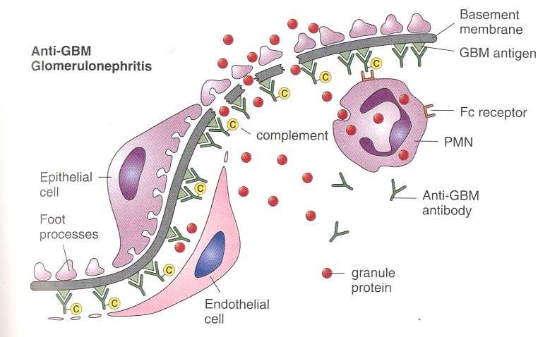 Antitestek kötődnek a GBM antigénné vált componenséhez