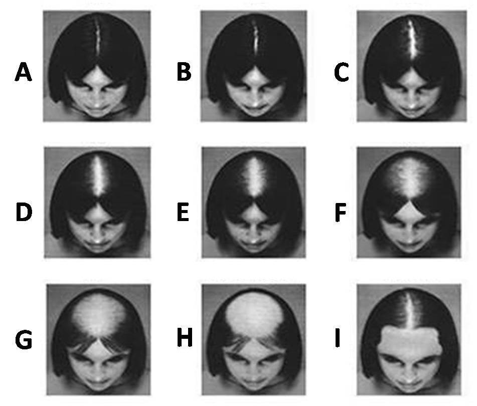 17. ábra. Savin-féle hajhullást diagnosztizáló skála (Dinh & Sinclair, 2007) 4.