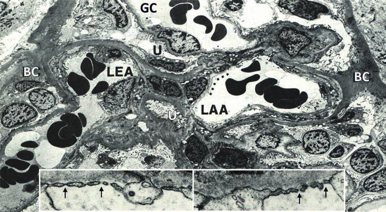 19. ábra: Human glomerulus keresztmetszeti elektronmikroszkópos képe az arteriolákban, számos vörösvértesttel Jól látszik, hogy az afferens arteriola disztális, extraglomeruláris mezangialis sejtek