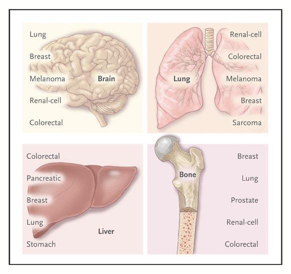 Szervspecificitás Patterns of Metastatic Spread of Solid