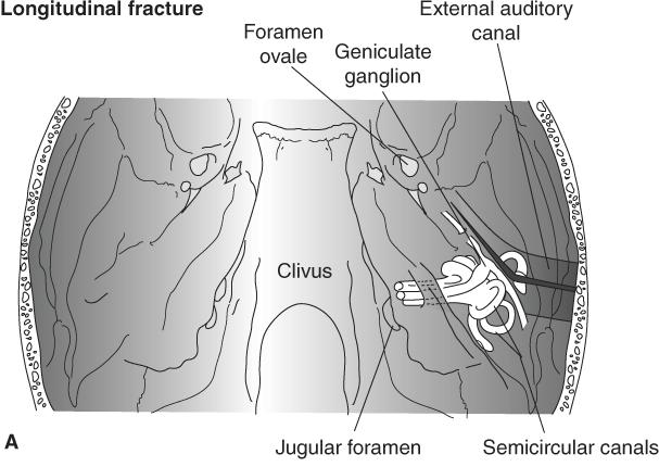 Hosszanti törés A pars petrosa, illetve a temporális csont töréseinek 80%-a Oldalirányú erők a sutura