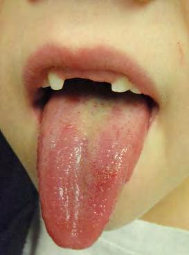 Aphtosus stomatitis